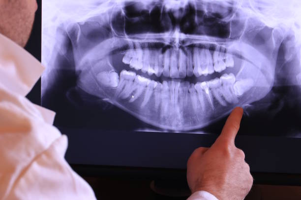 Best Emergency Dental Extractions in East Port Orchard, WA